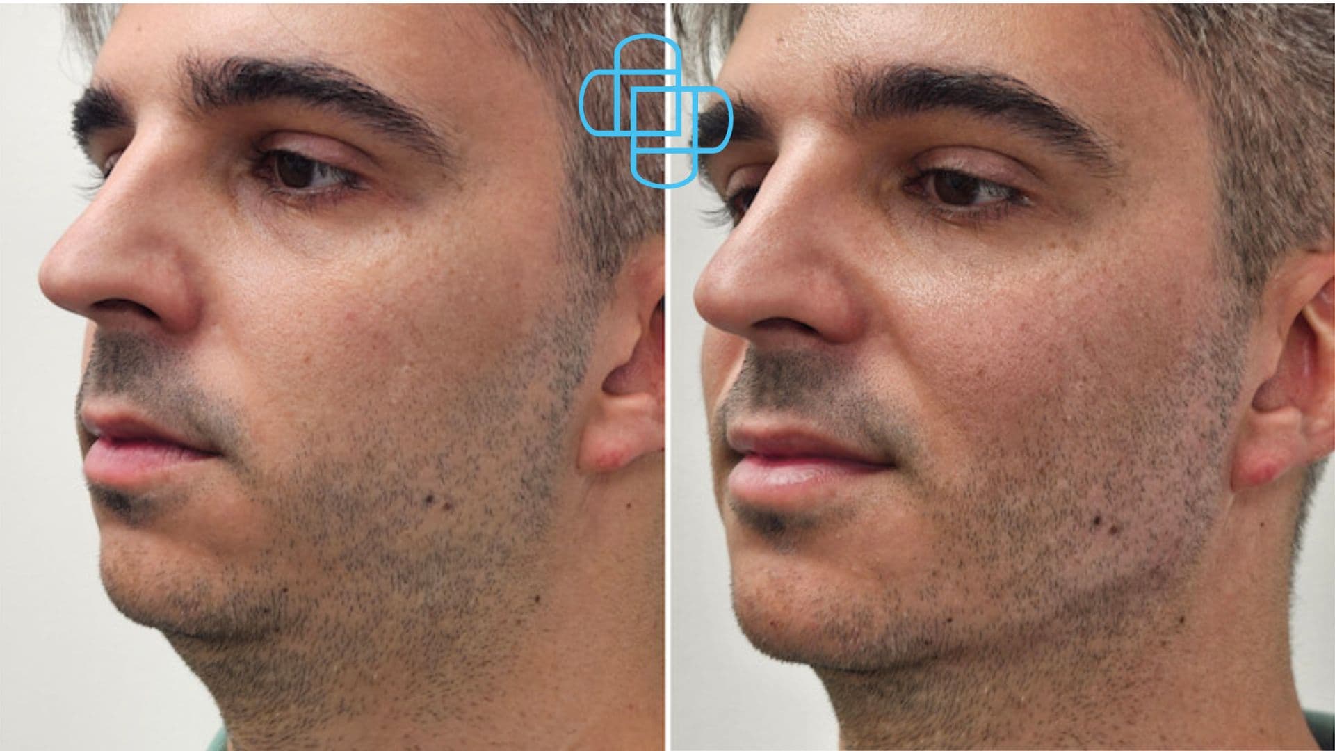 Antes y después: Ácido Hialurónico en Reborde Mandibular y Mentón