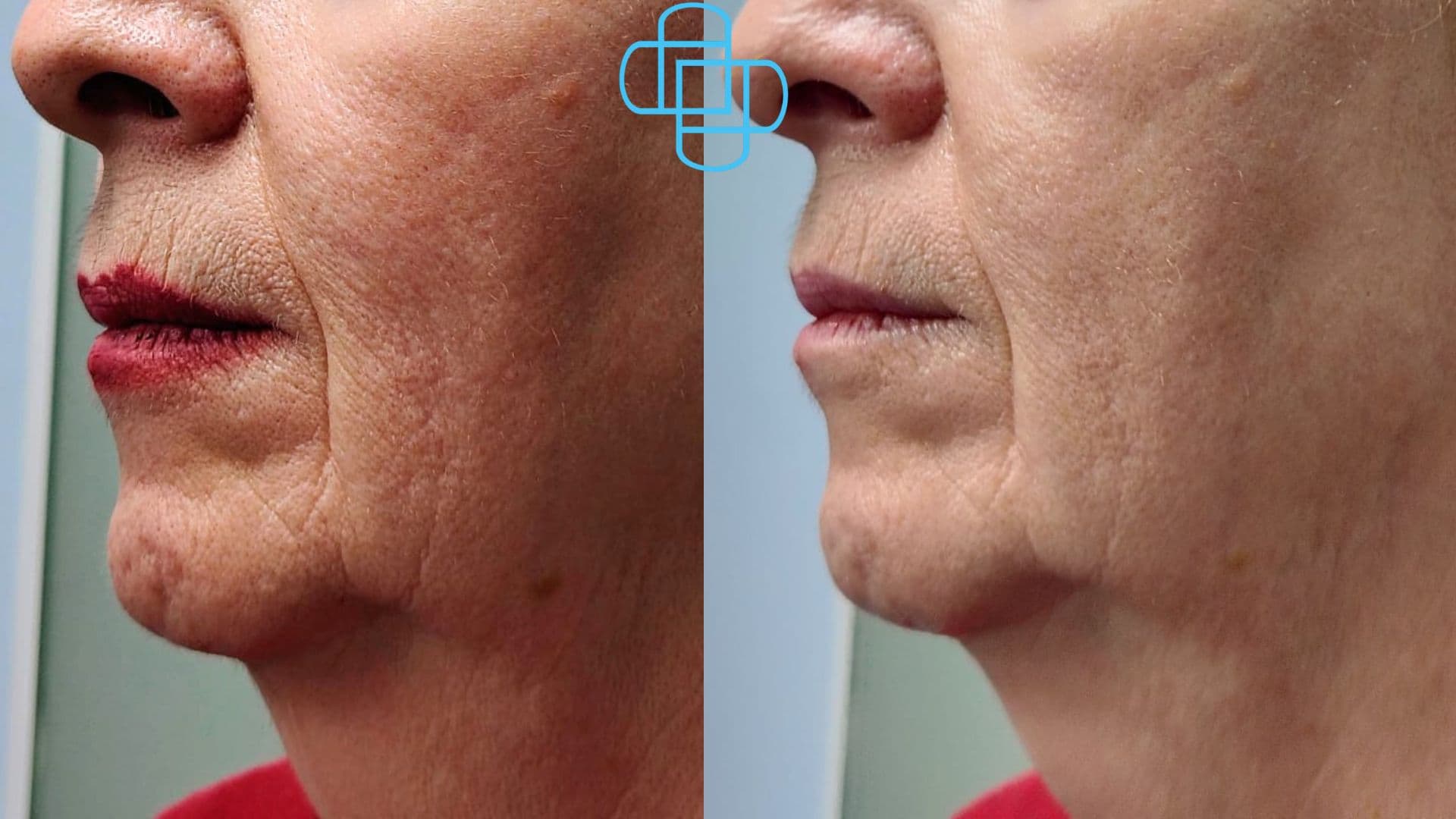 Antes y después: Hidratación Facial Cosmetológica