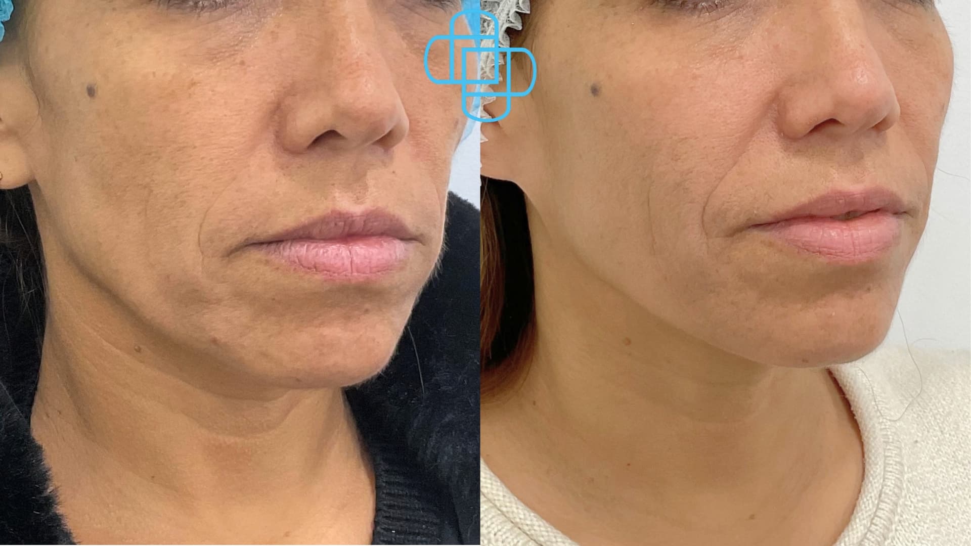 Antes y después: HIFU Liftera A2 Rostro Completo