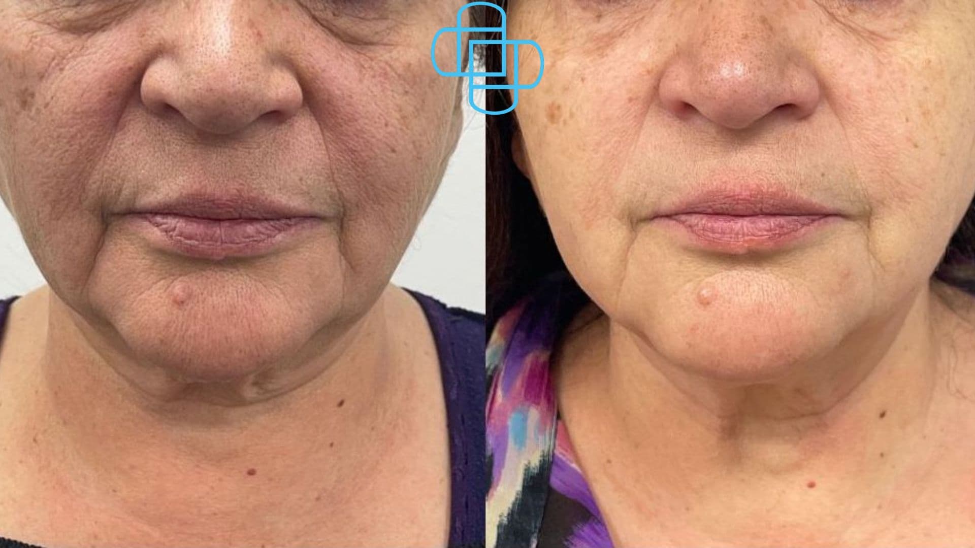 Antes y después: HIFU Liftera Rostro Completo