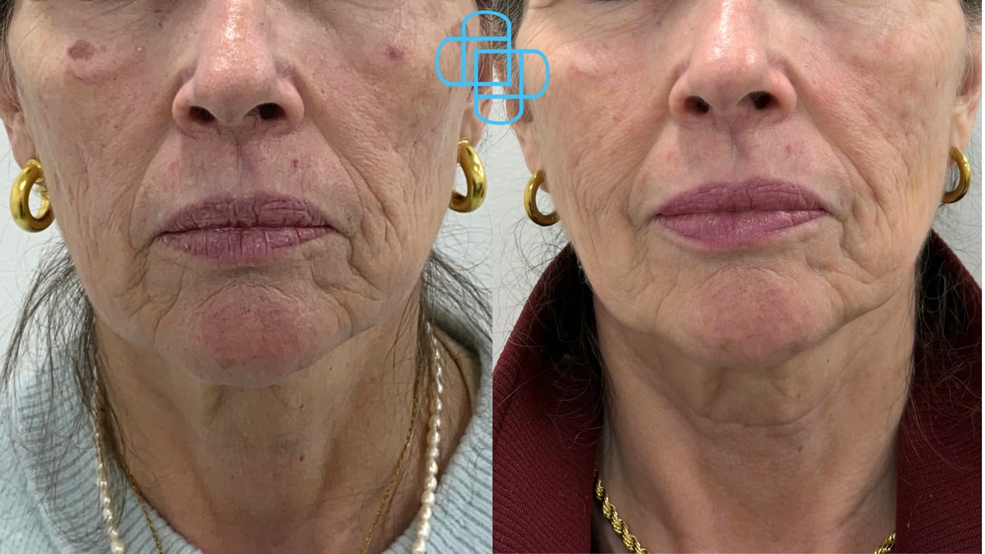 Antes y después: HIFU Liftera Rostro Completo