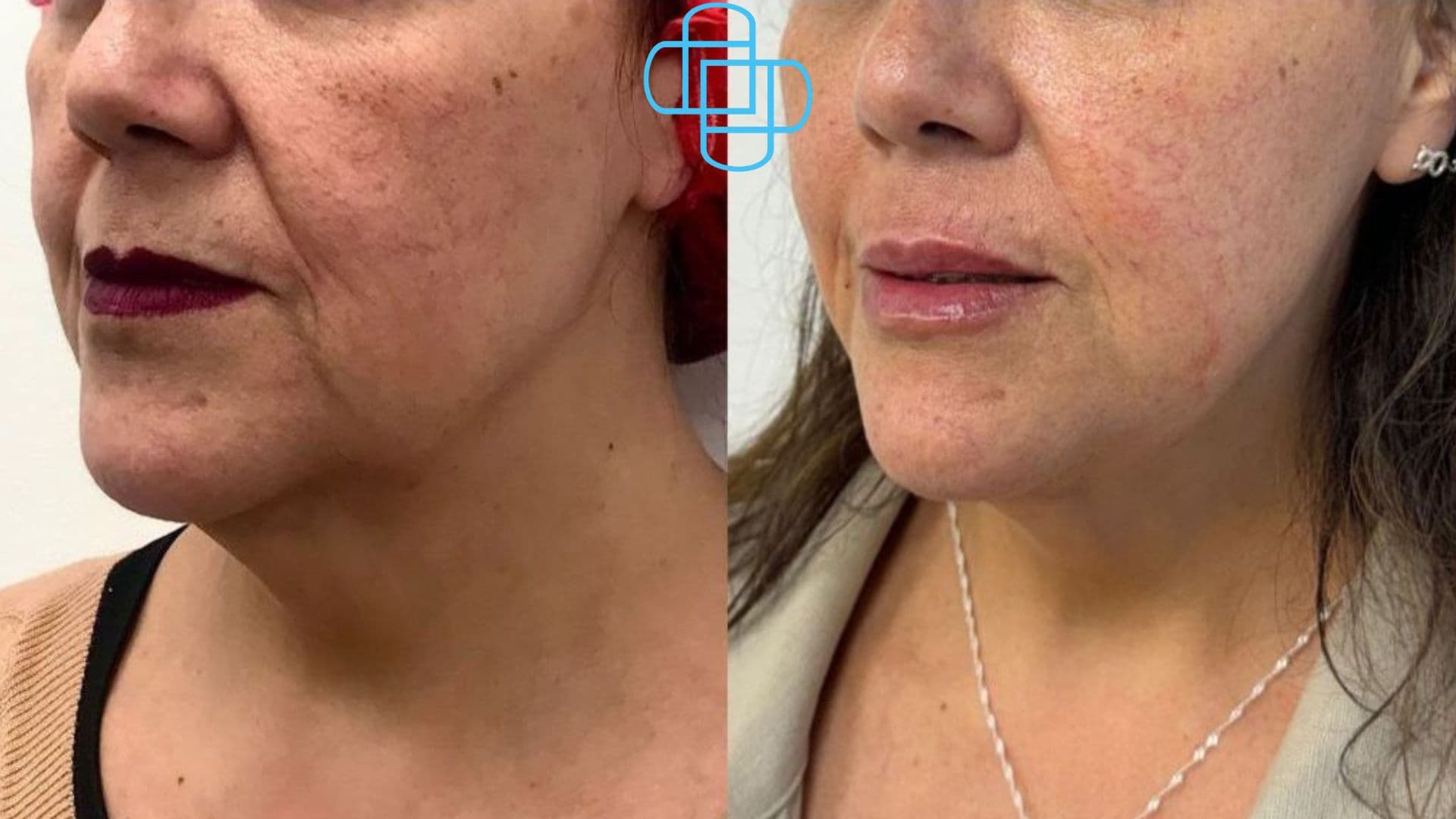 Antes y después: HIFU Liftera y Relleno de Labios