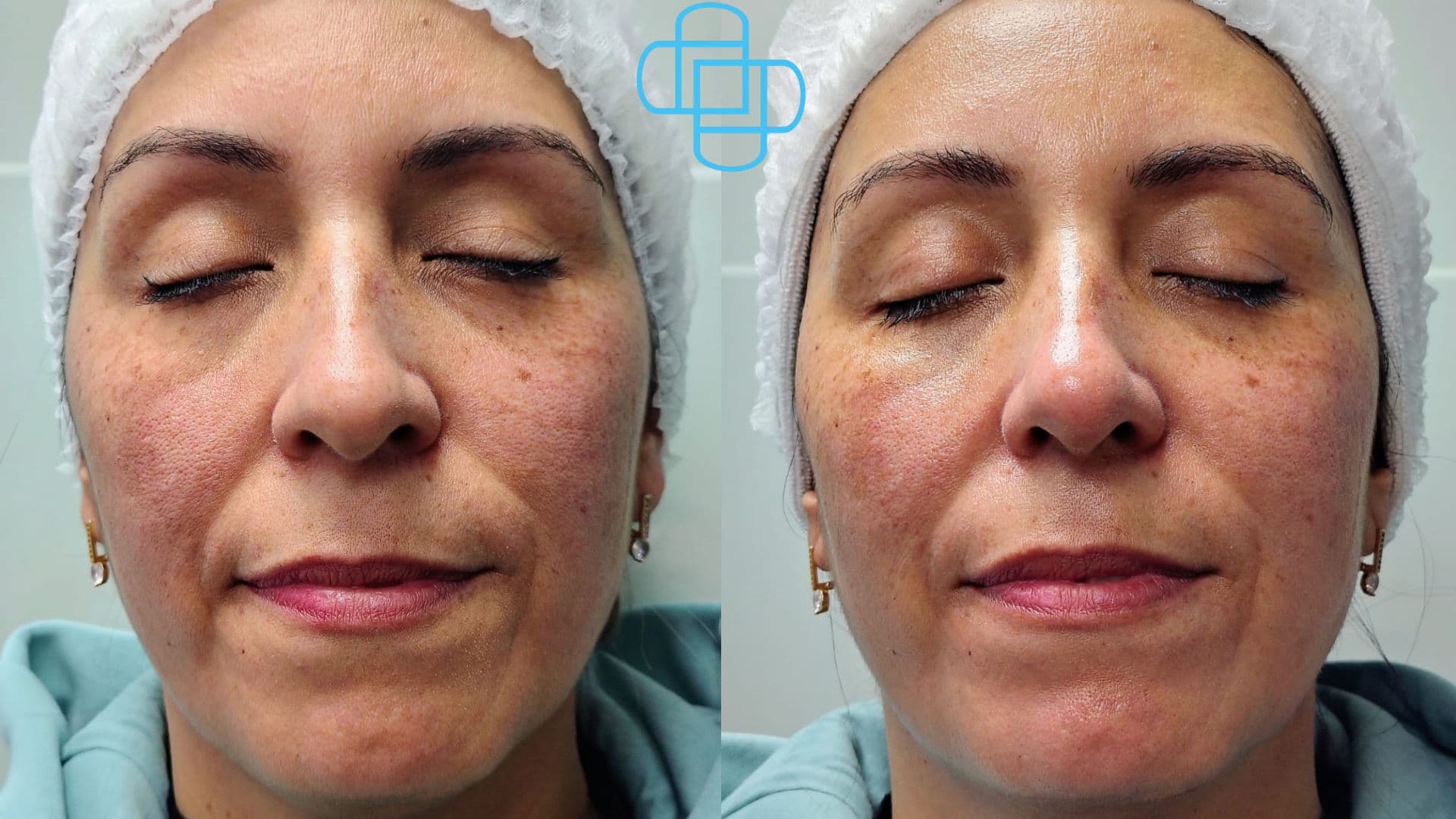 Antes y después: Limpieza Facial Profunda Cosmetológica