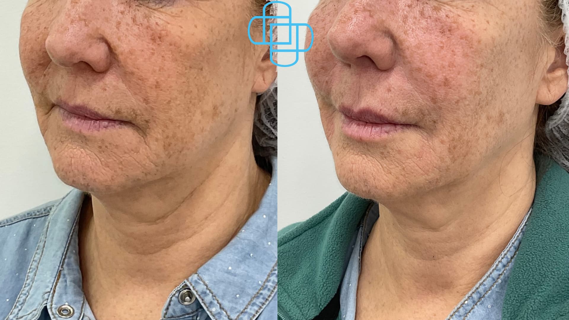 Antes y después: Perfilado e Hidratación de Labios