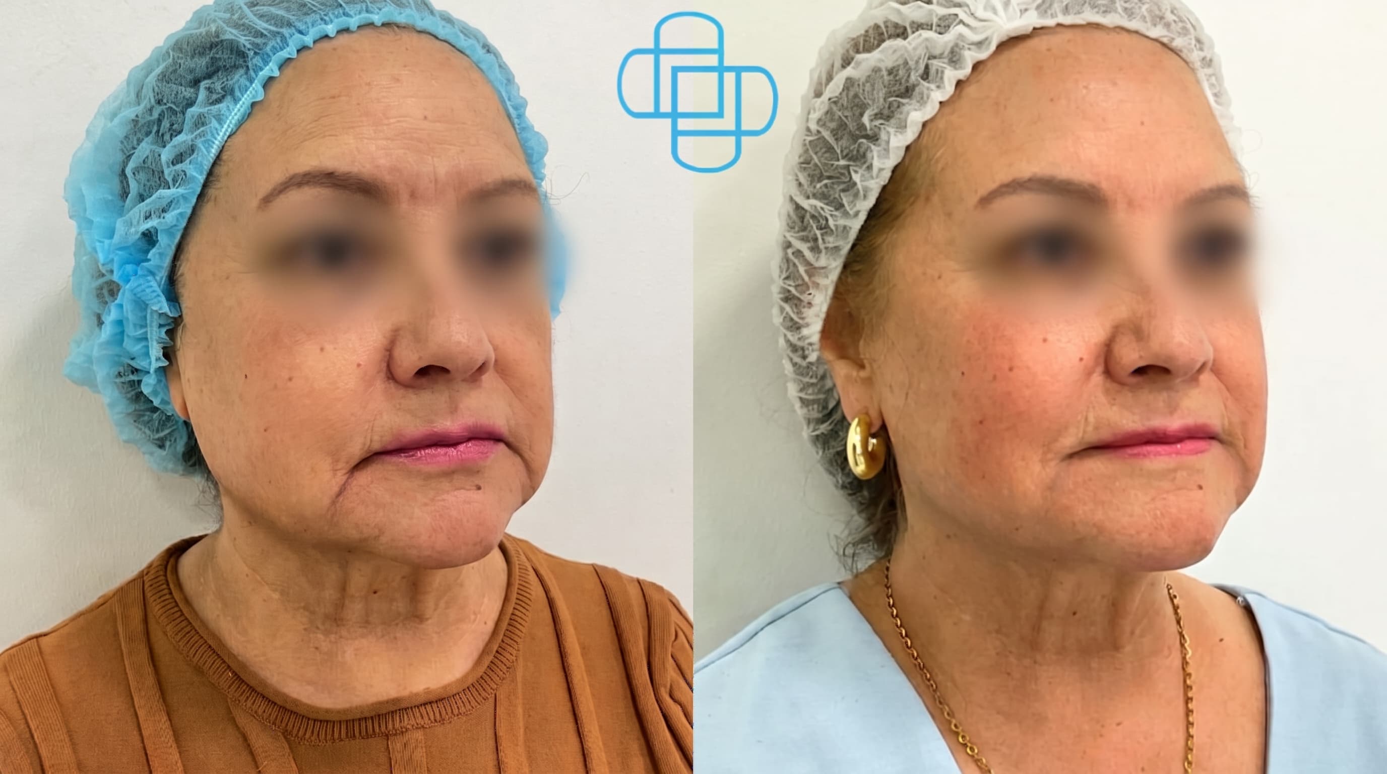 Antes y después: Rejuvenecimiento Facial