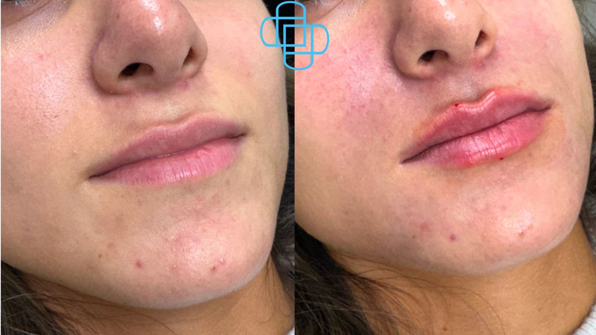 Antes y después: Relleno de Labios con Ácido Hialurónico