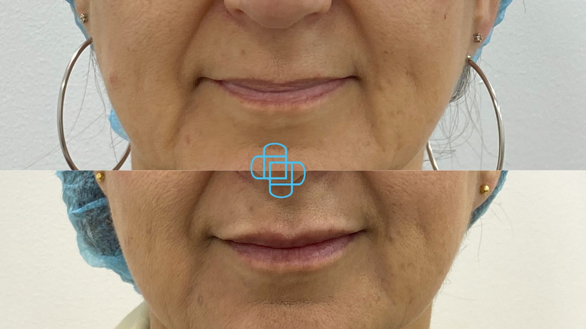Antes y después: Relleno e Hidratación de Labios con Ácido Hialurónico