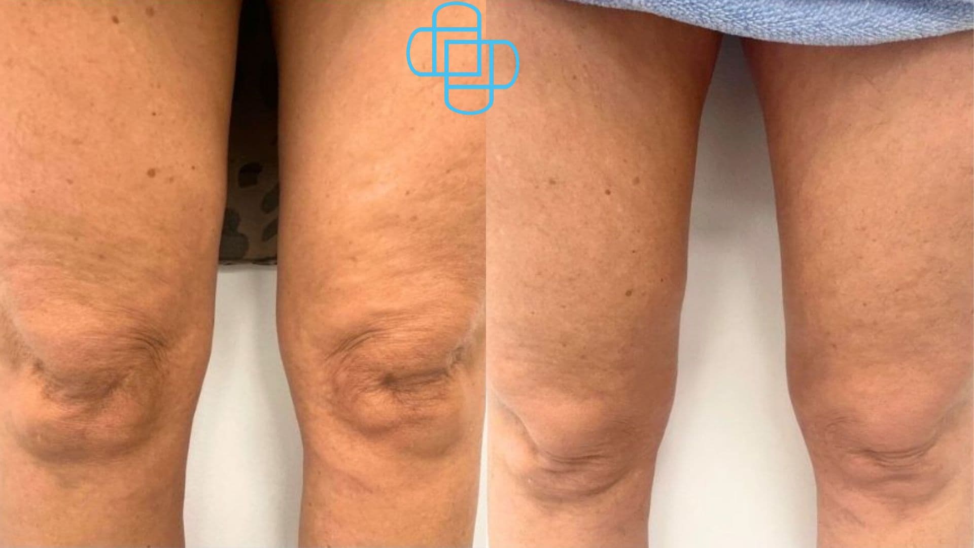 Antes y después: Sculptra Corporal Piernas