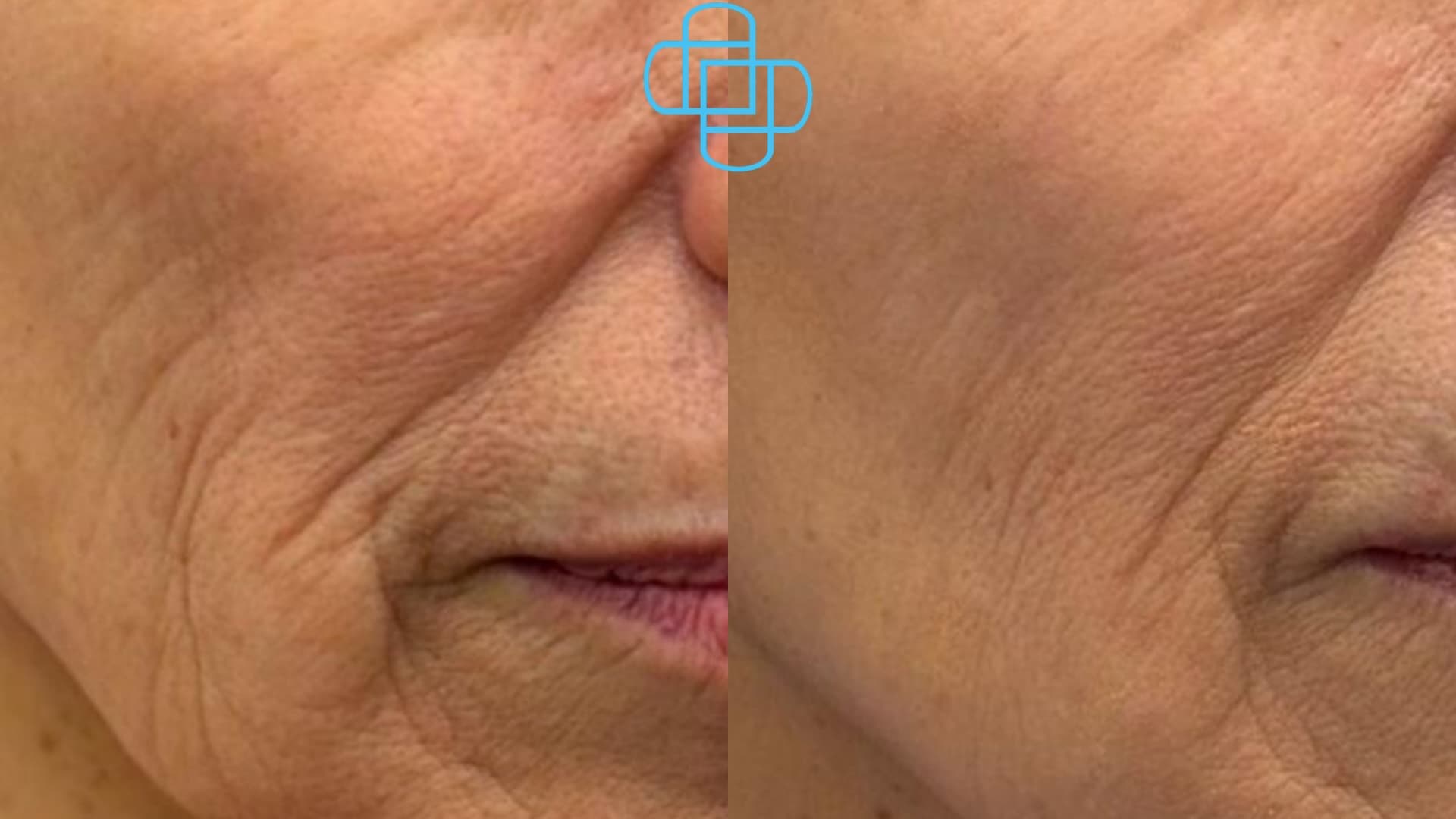 Antes y después: Sculptra disminuye arreguas finas y elimina flacidez
