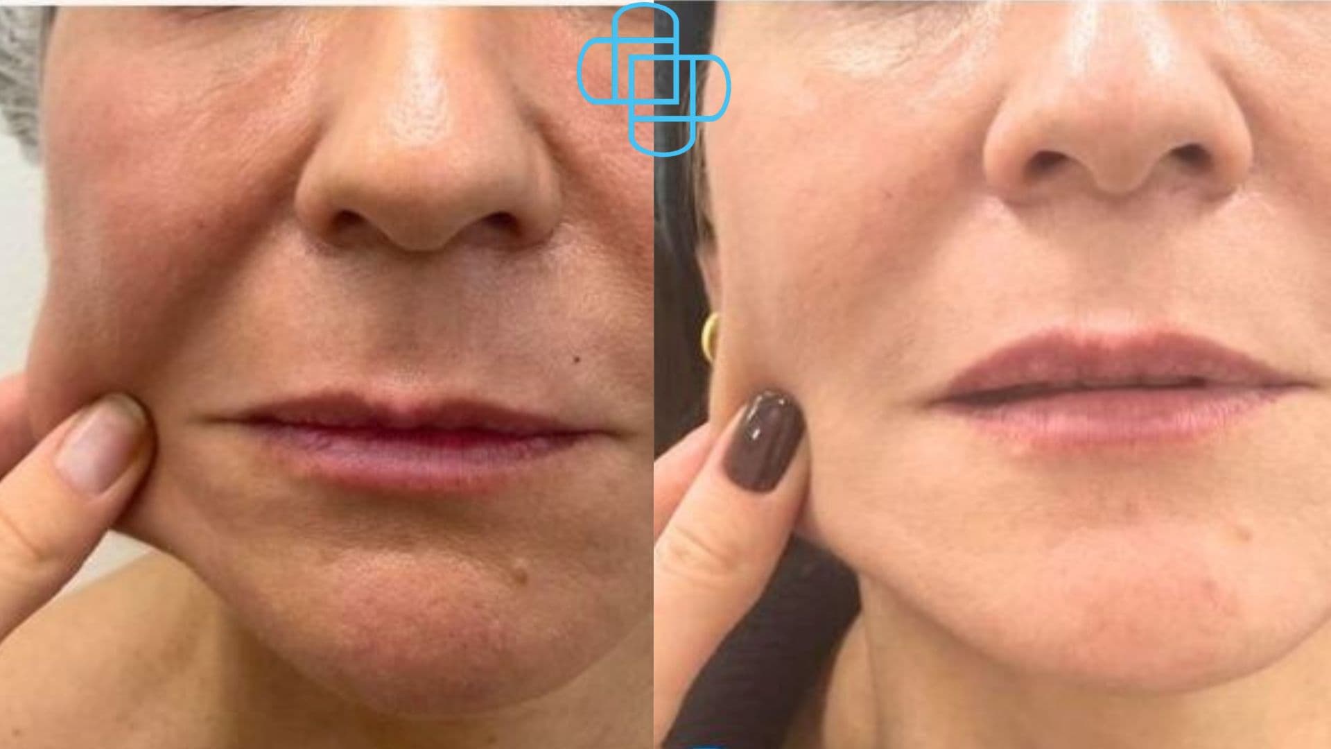 Antes y después: Sculptra Facial