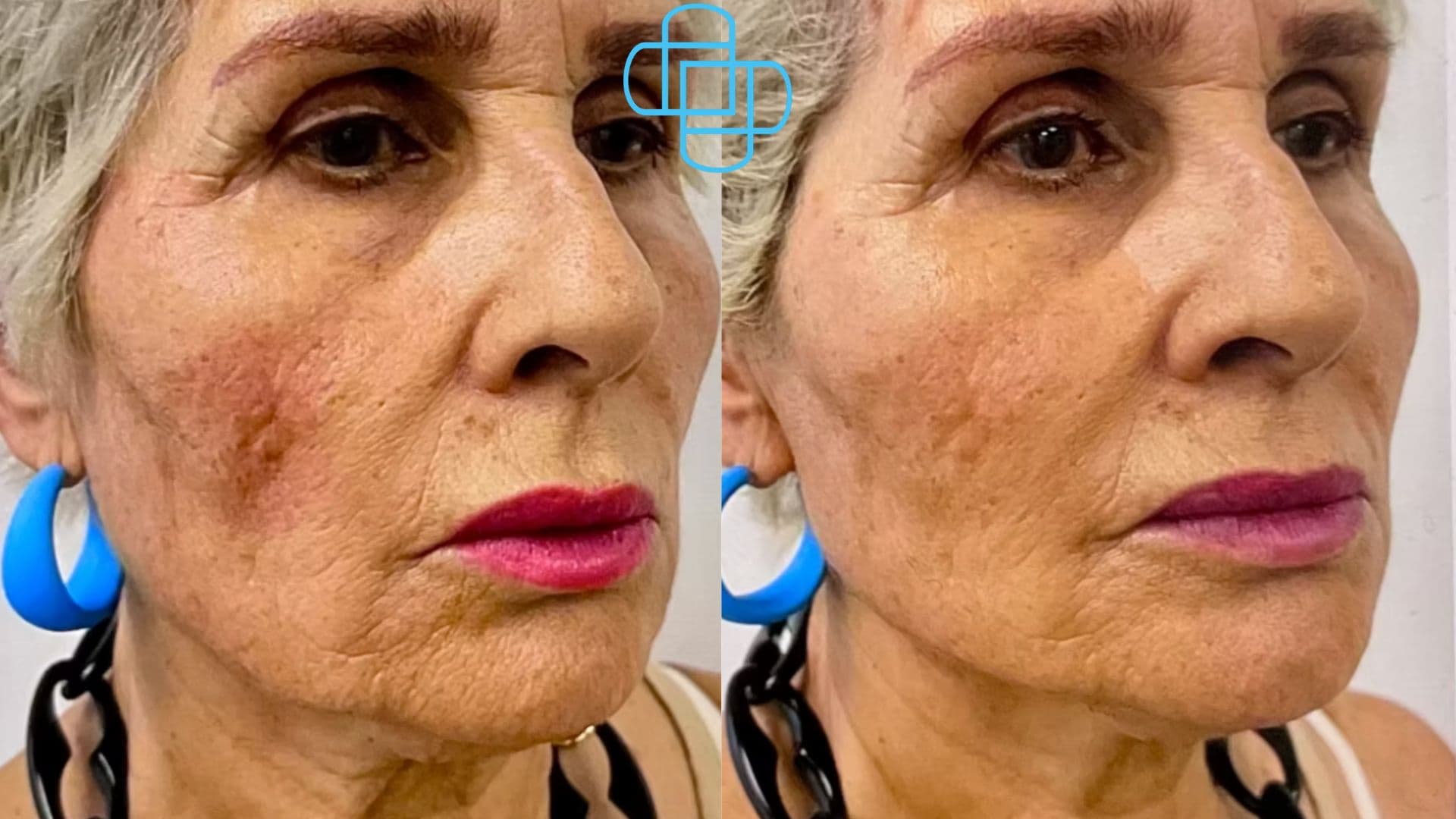 Antes y después: Sculptra Rostro