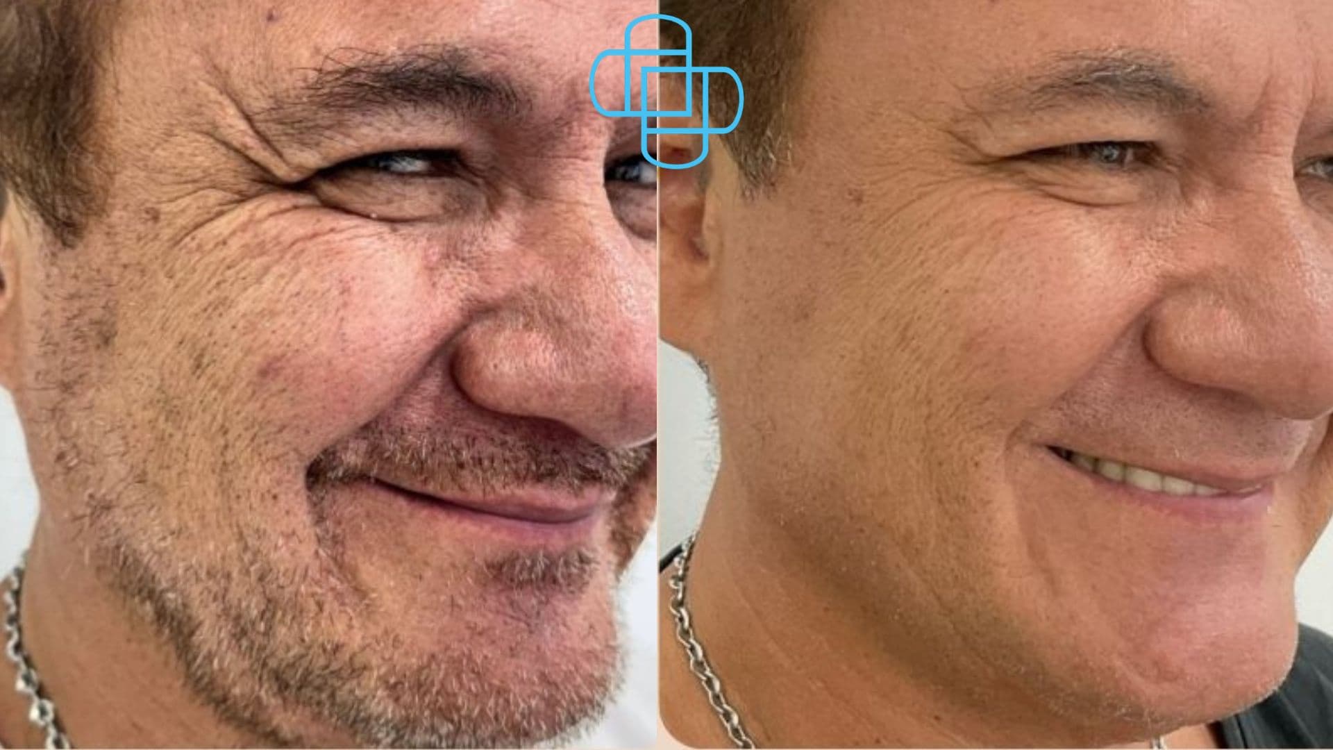 Antes y después: Toxina Botulínica en "Patas de Gallo"